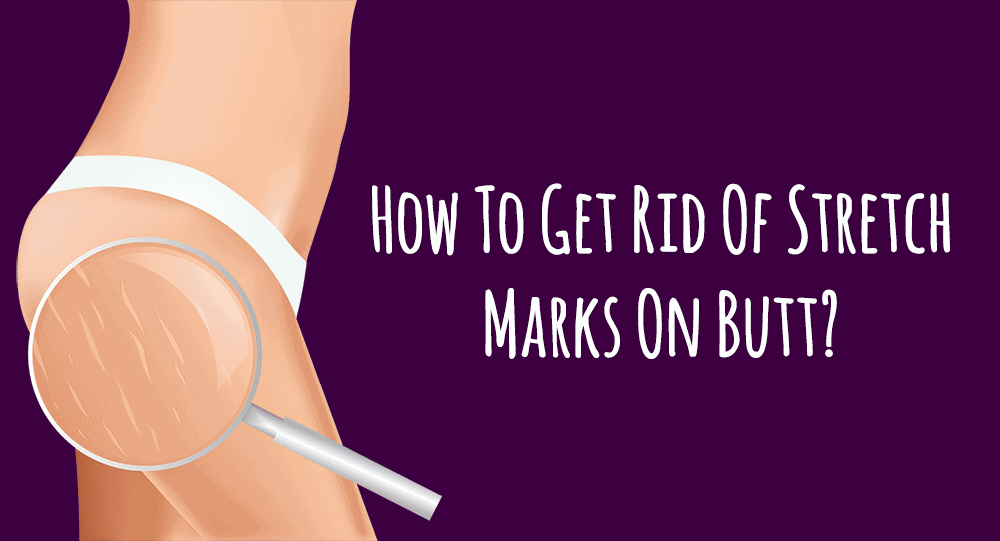 How-to-get-rid-of-stretch-marks-on-butt?