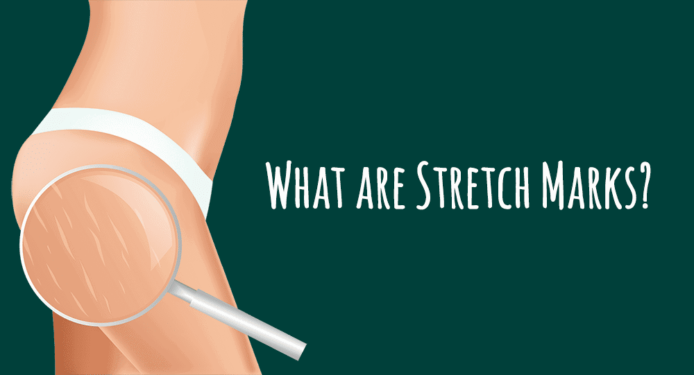 What-are-stretch-marks?