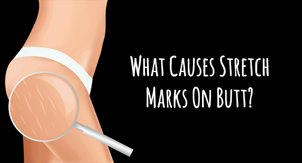 What Causes Stretch Marks On Butt?
