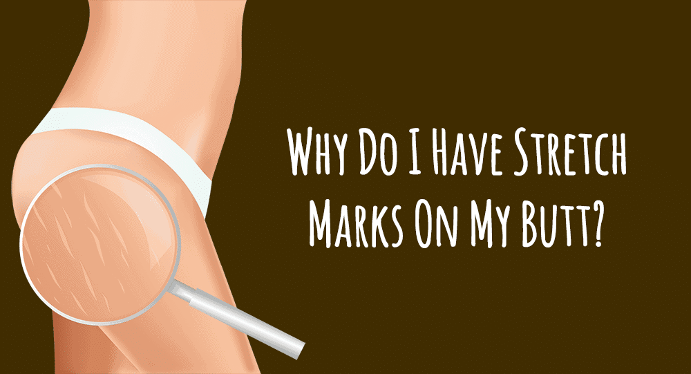 Why Do I Have Stretch Marks On My Butt?